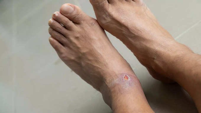 Don't forget only 4 things to prevent diabetic foot ulcers and follow..!-oneindia news