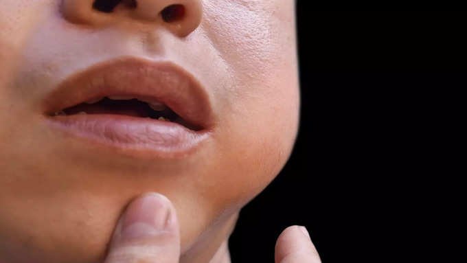 If the child's chin..jaw..is swollen it may be swollen and mumps in the baby..what are the other symptoms..?-oneindia news